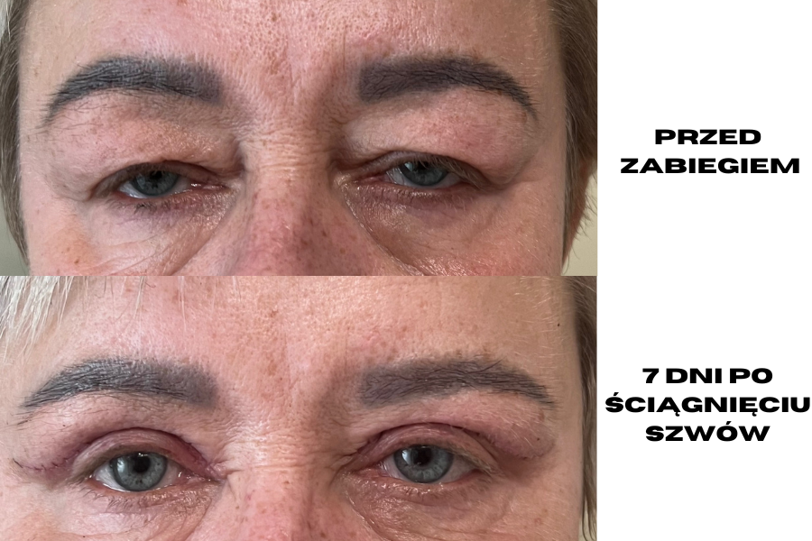 Efekty zabiegu plastyki powiek Efekty zabiegu plastyki powiek