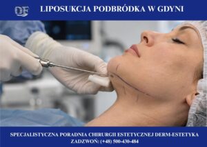 podwójny podbródek zabieg, gdynia, gdańsk